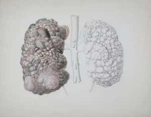Medical illustration showing damaged lung alveoli caused by smoking and COPD, highlighting irreversible air sac destruction and reduced lung function.