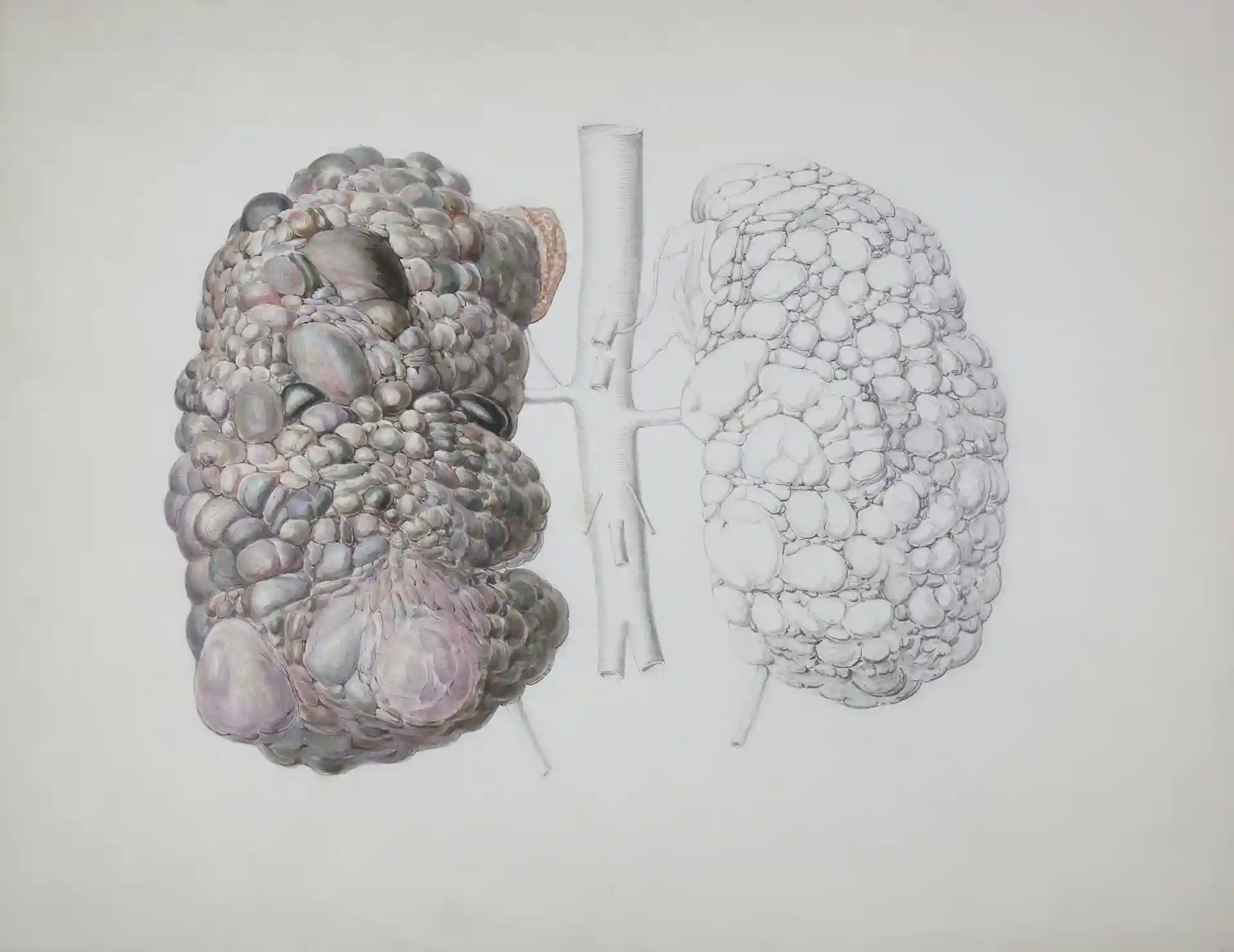 Medical illustration showing damaged lung alveoli caused by smoking and COPD, highlighting irreversible air sac destruction and reduced lung function.