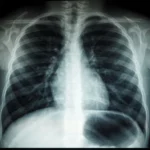 Chest X-ray image illustrating lung changes associated with smoking, chronic bronchitis, COPD, coughing, mucus production, and reduced FEV1 lung function.