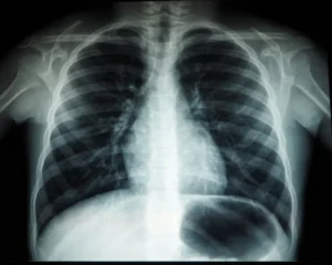 Chest X-ray image illustrating lung changes associated with smoking, chronic bronchitis, COPD, coughing, mucus production, and reduced FEV1 lung function.